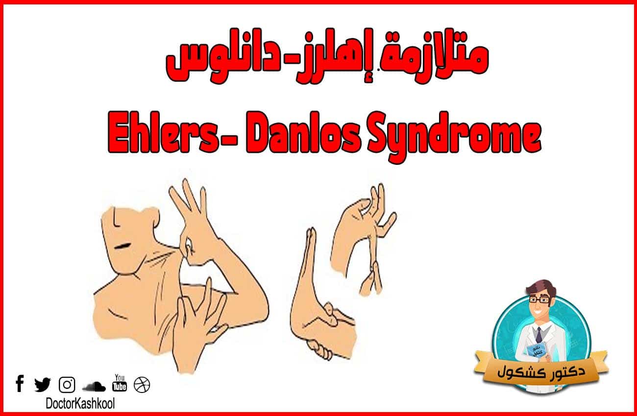 متلازمة إهرلز- دانلوس Ehlers- Danlos Syndrome